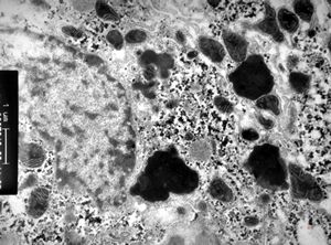F,7m. | giant cell hepatitis